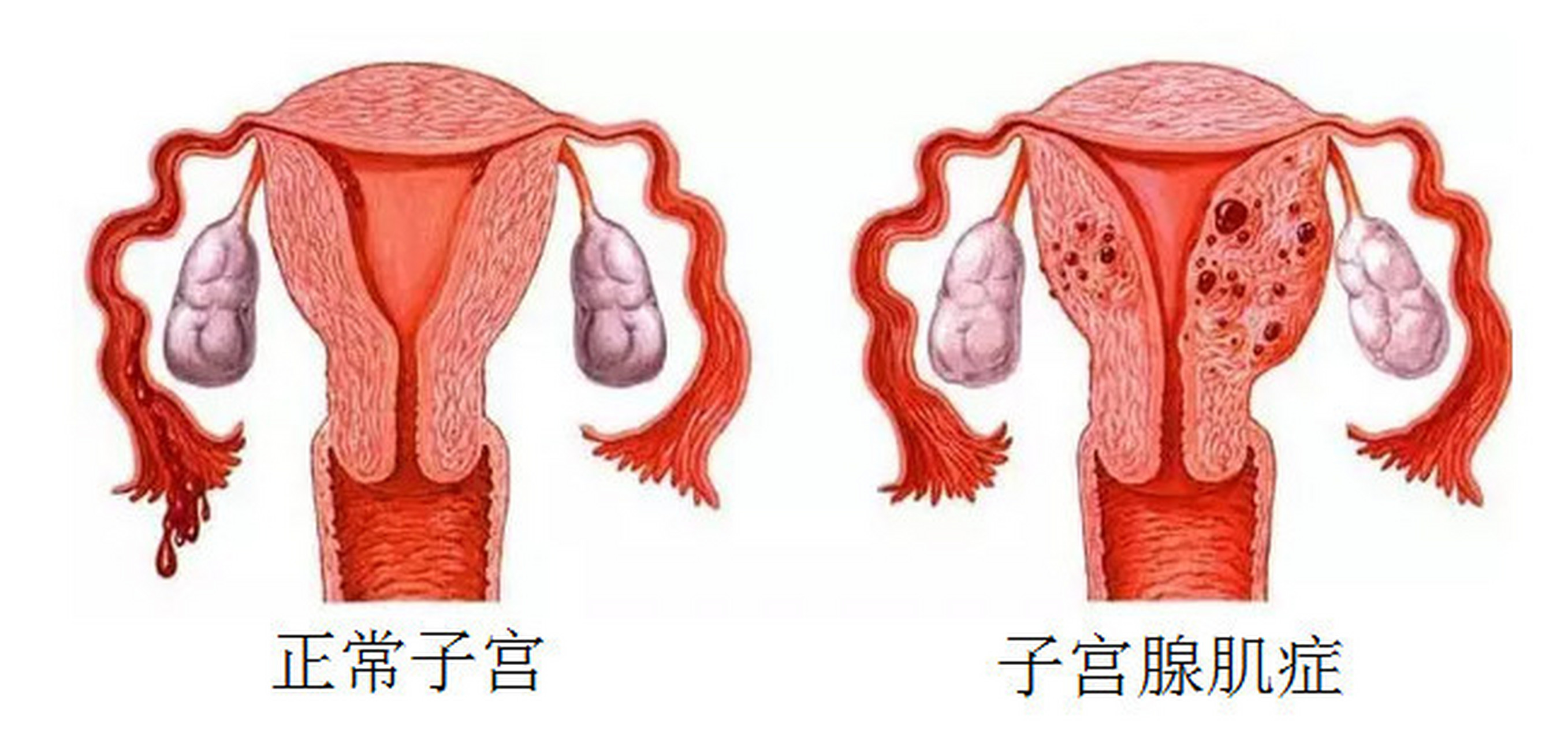 子宫腺肌症如何才能顺利怀孕?